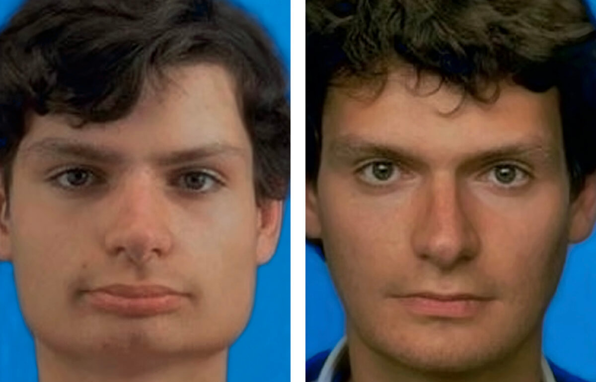 Dysgnathie-breites-Gesicht-vorher-nachher2.jpg