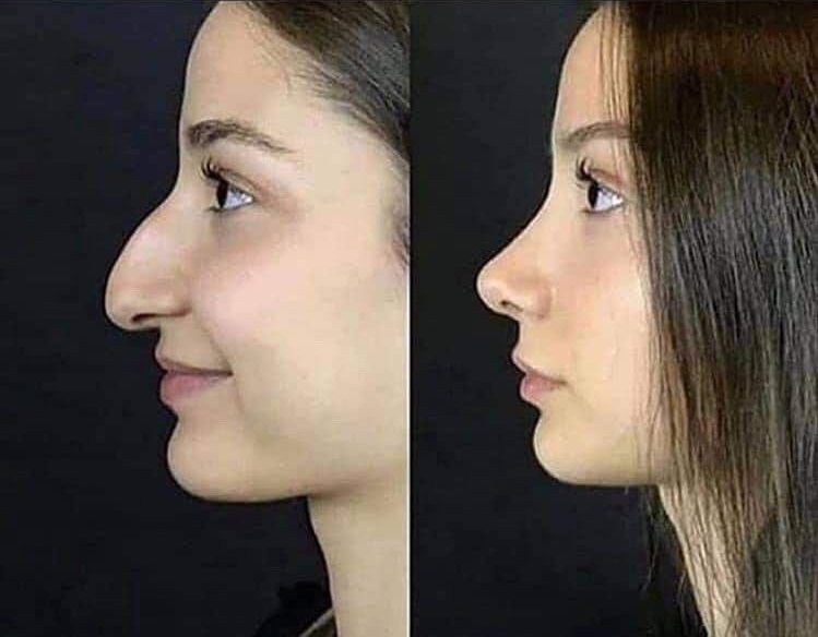 nosejob-2.jpg
