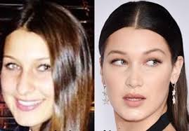 Bella Hadid Plastic Surgery (1) | Plastic surgery, Gigi hadid ...