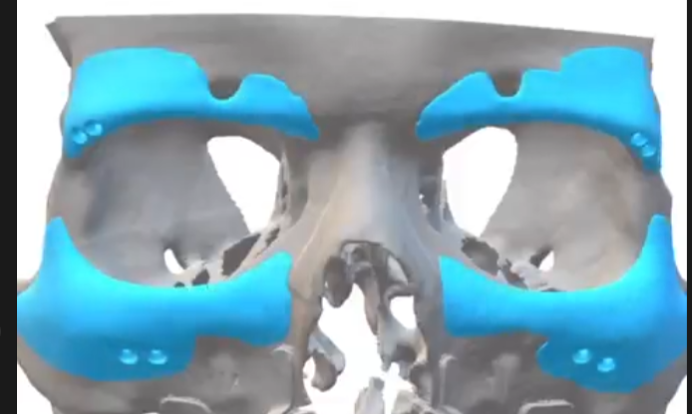 3358869_implant.png