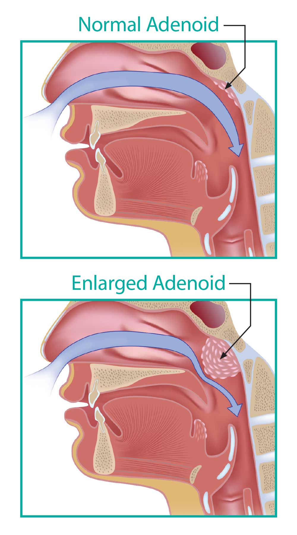 normal-vs-enlarged-adenoid.jpg