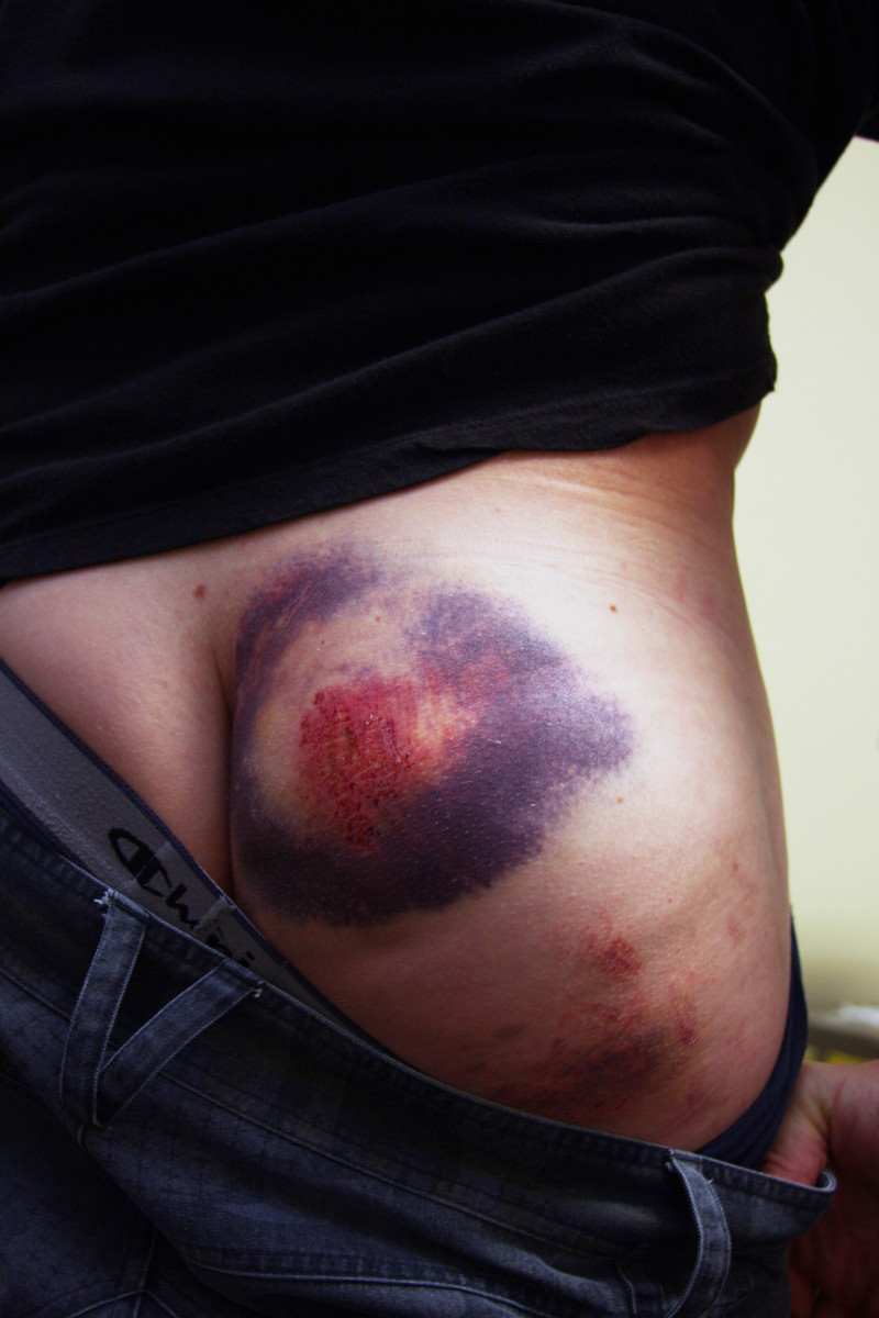 Bikemag's big-ass bruises contest - BikeMag