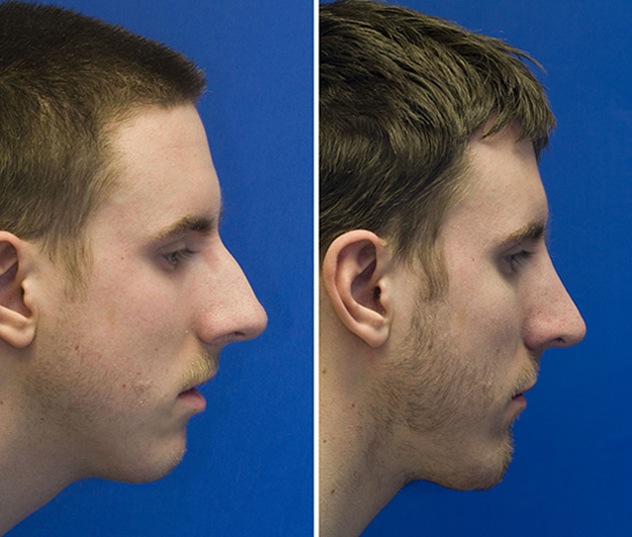 chin-implant-before-and-after-photos.jpg