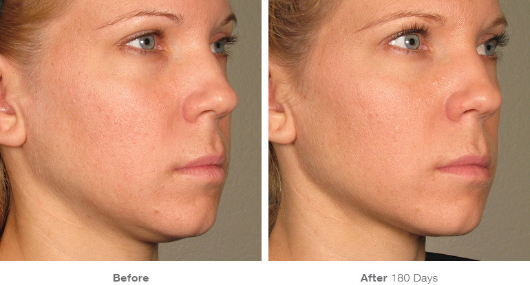before_after_ultherapy_results_full-face23.jpg