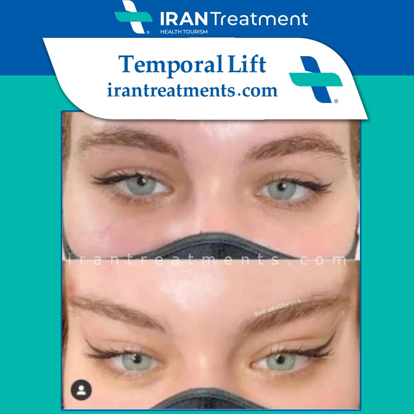 irantreat-insta-temporal.jpg