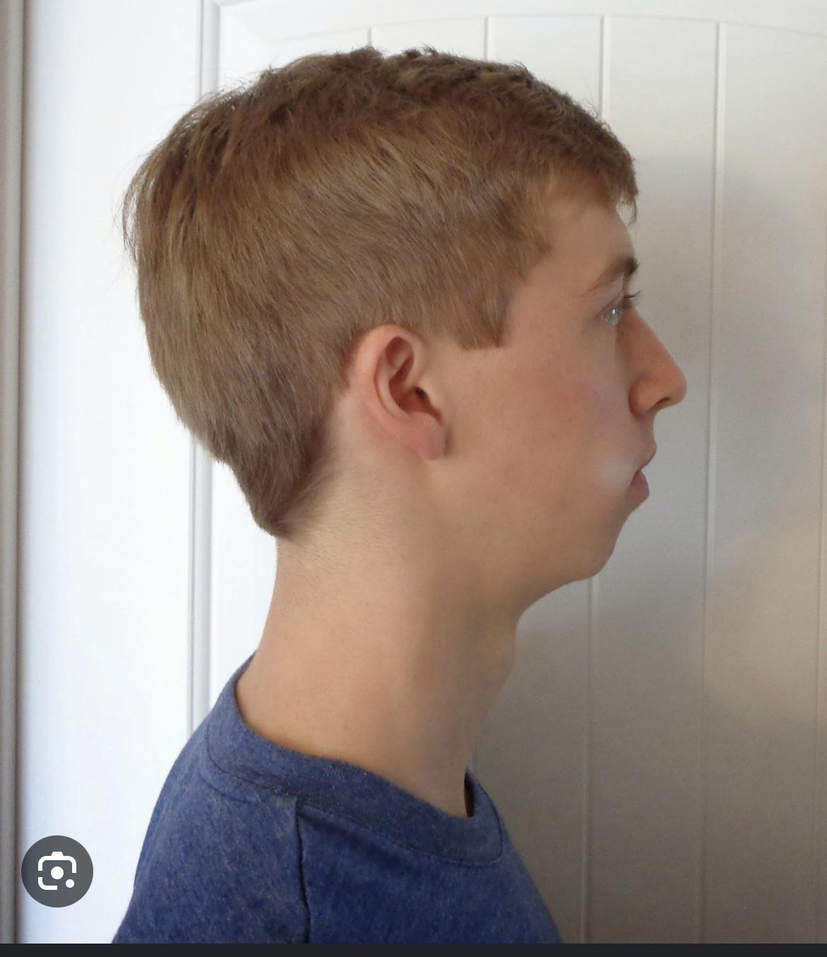 gUyS aM i rEcEsSeD : r/orthotropics