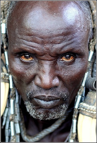 African man jaundiced eyes