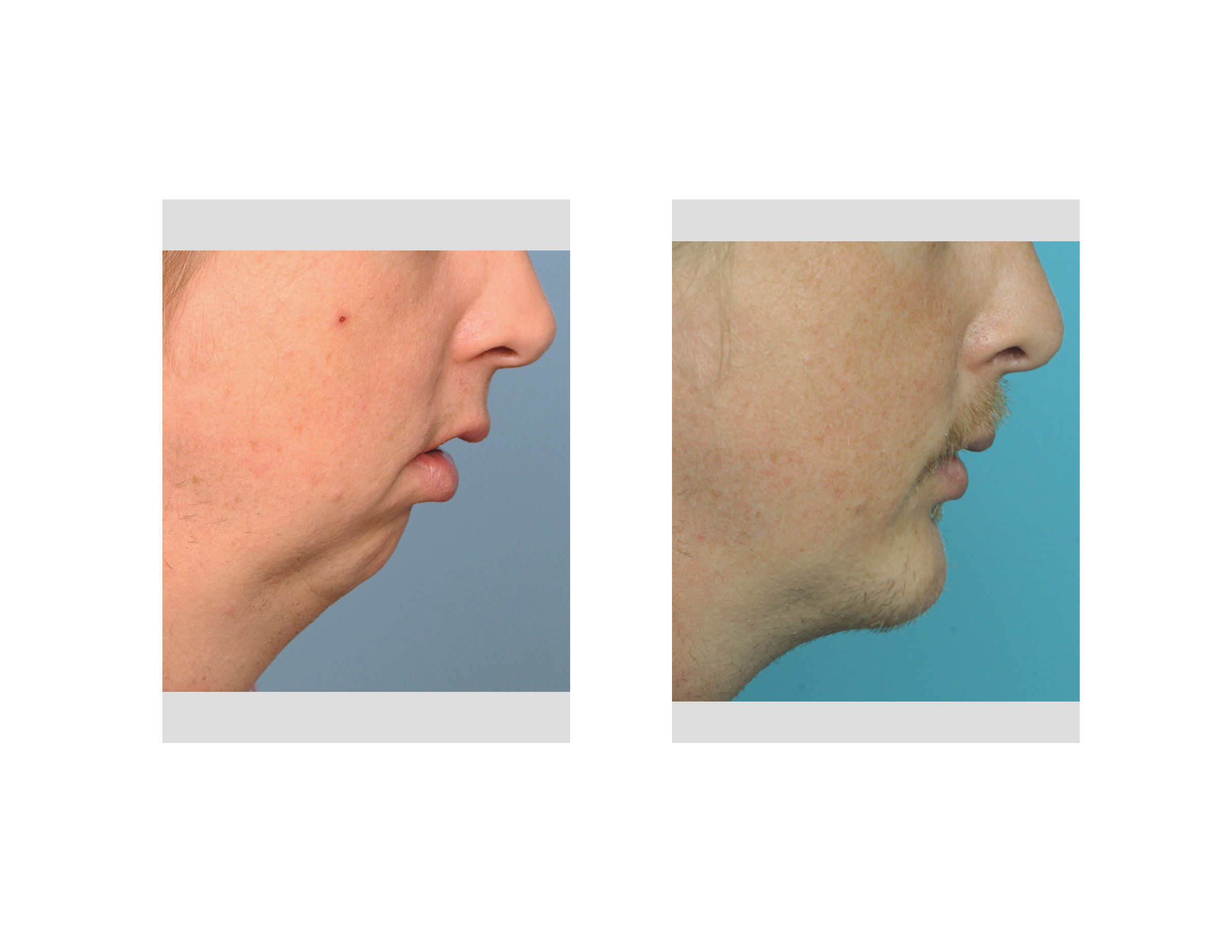 Chin-Osteotomy-and-Implant-Augmentation-result-side-view-Dr-Barry-Eppley-Indianapolis.jpg