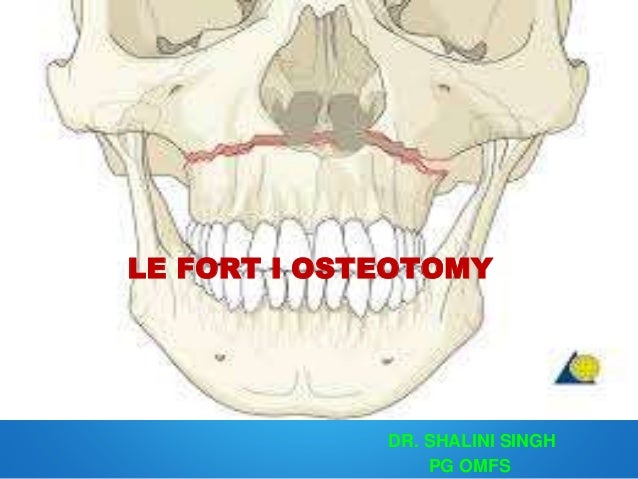 lefort-1-osteotomy-1-638.jpg