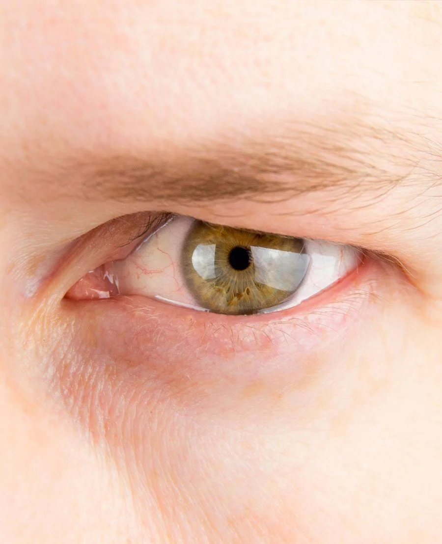 Condition-Ptosis-2.jpg.webp