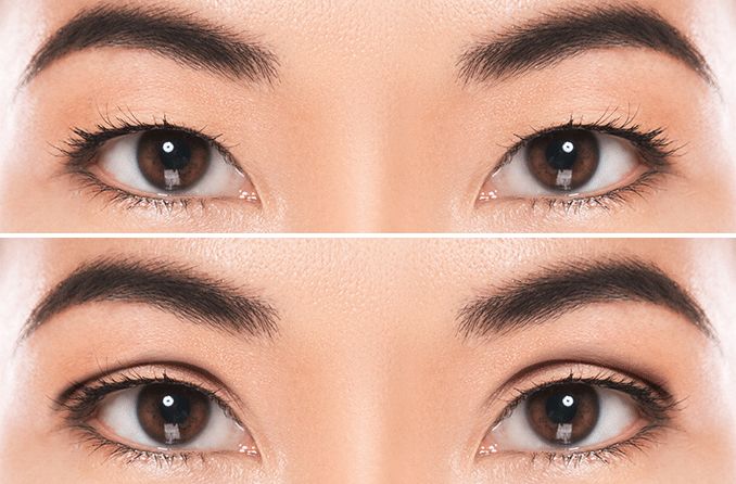 double-eyelid-surgery-678x446.gif