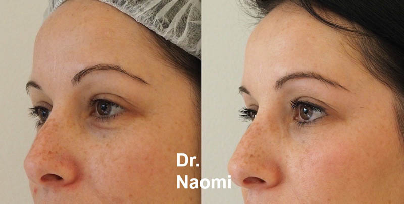 before-and-after-dermal-filler-tear-trough.jpg