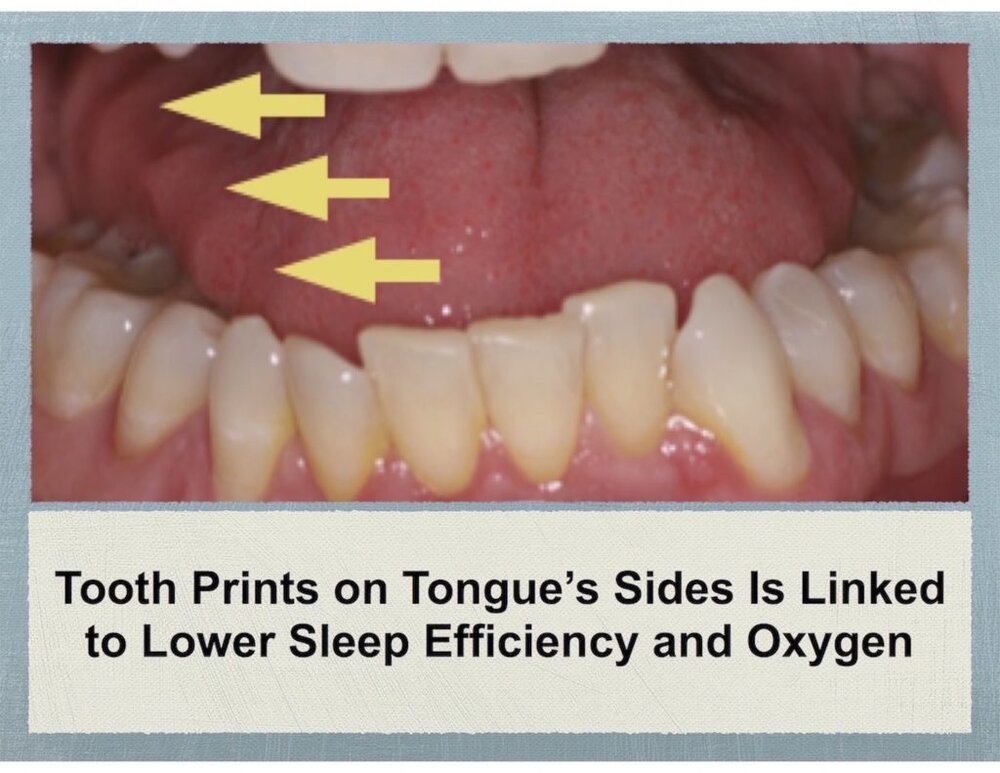 Tooth prints on tongue 1024x791