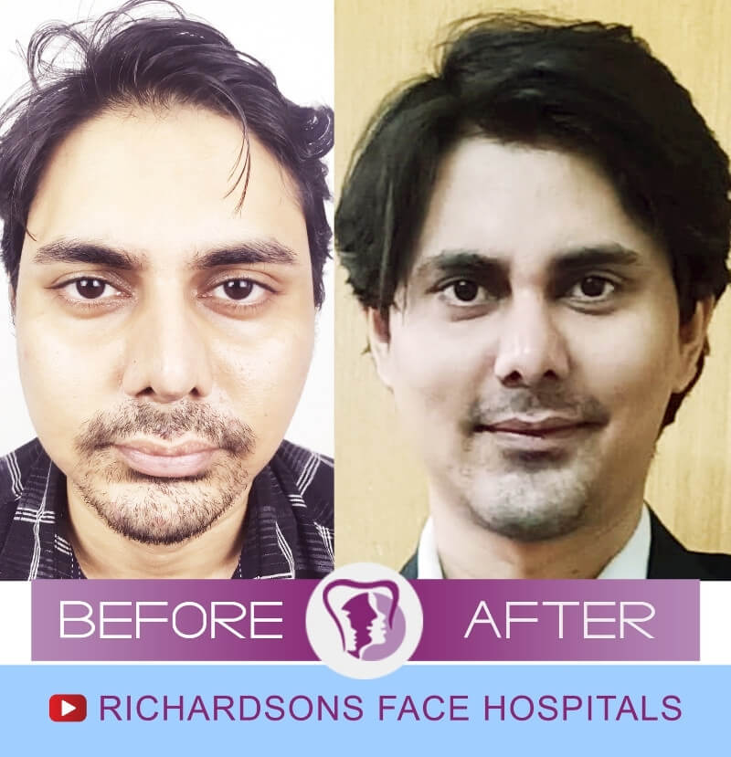 Rahul-Genioplasty-Surgery.jpg