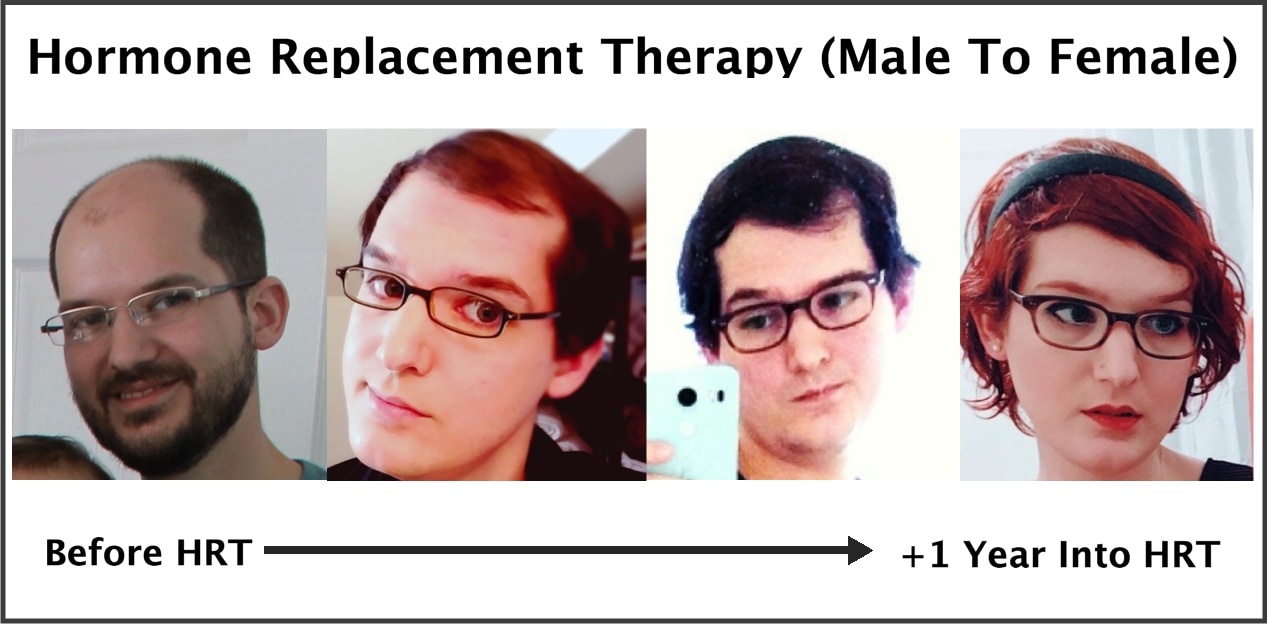 hormone-replacement-therapy-transgender-hair-regrowth.jpg