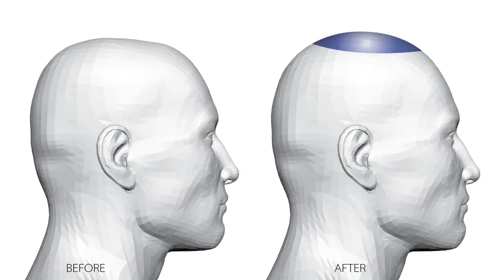Crown Skull Reshaping - Line Plastic Surgery Center