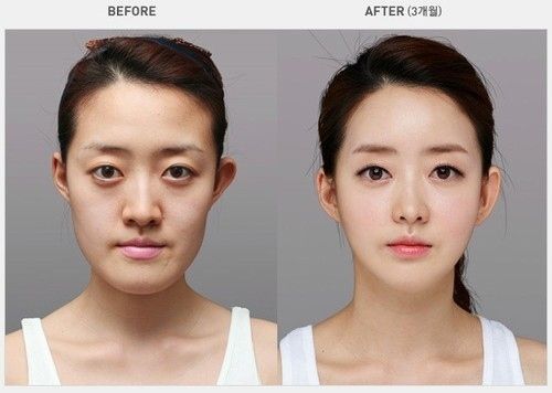 a5f05d6c4be5f1bda4b97f5e432d36d2--korean-plastic-surgery-korean-surgery.jpg