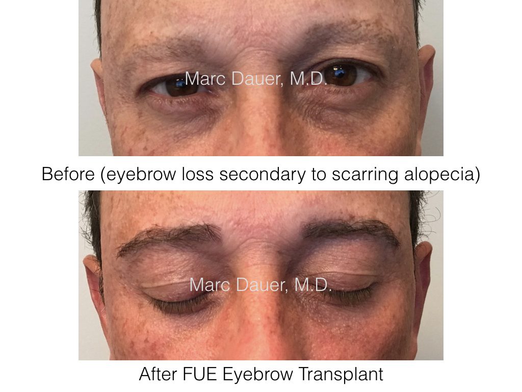 FUE Eyebrow Transplant In A Male Patient With Scarring Alopecia ...