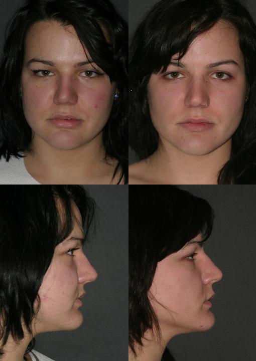 Before_%26_After_Buccal_Fat_Extraction.JPG