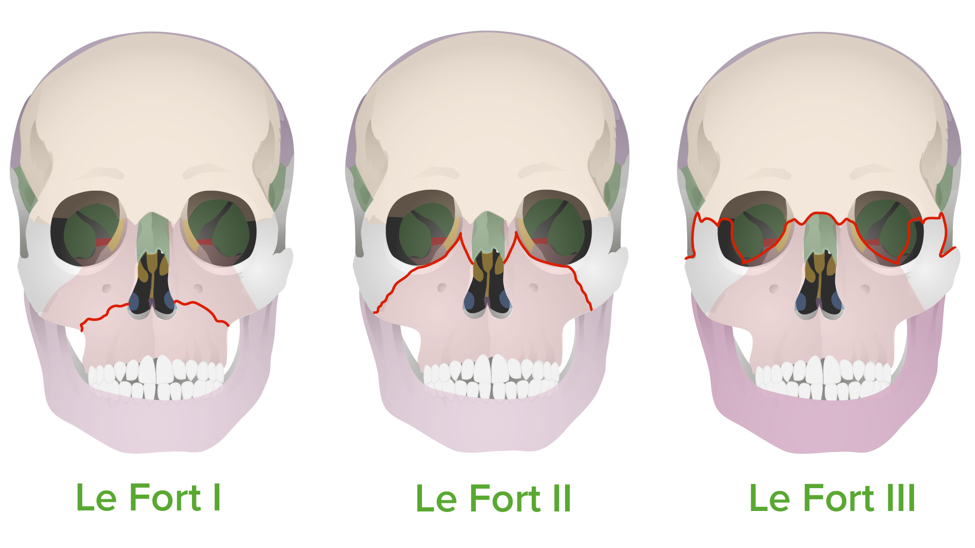 Le Fort fracture types