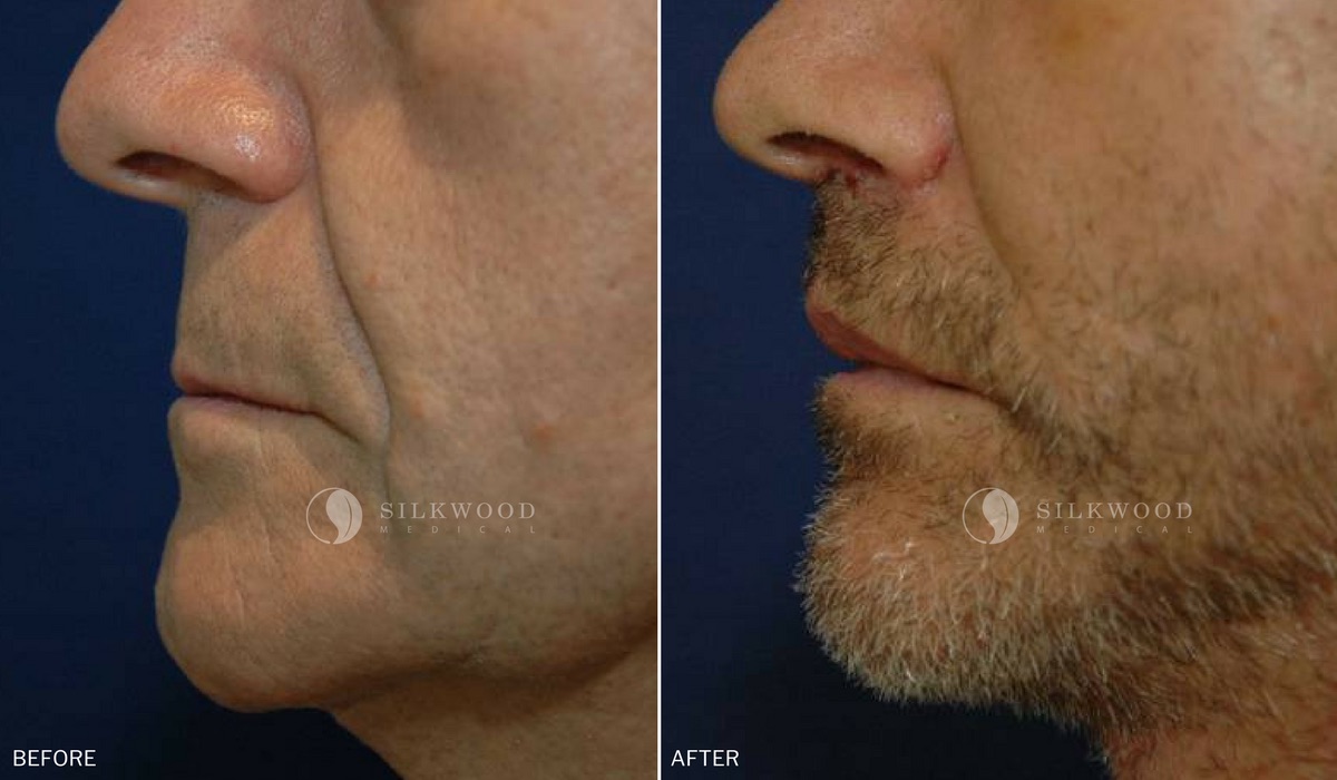 Lip Lift Shortening Sydney | Lip Lift Surgery Dr Warwick Nettle Sydney