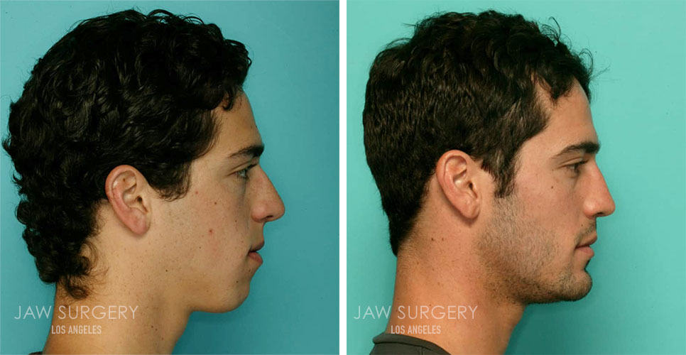 Before & After Photos | Los Angeles, CA | Jaw Surgery LA