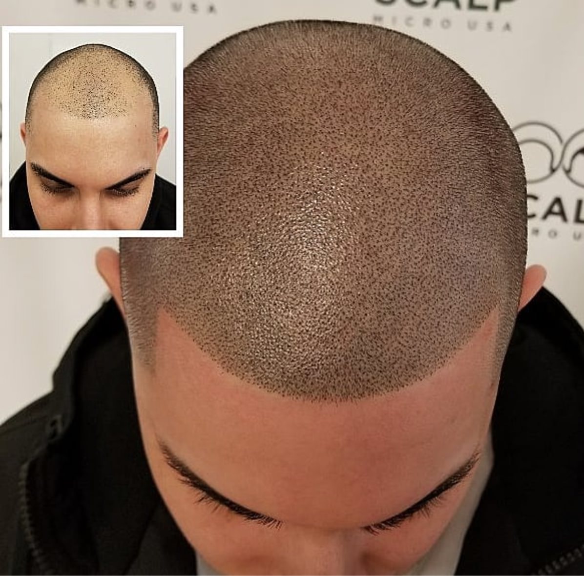 scalp-micropigmentation-hair-pigmentation.jpg