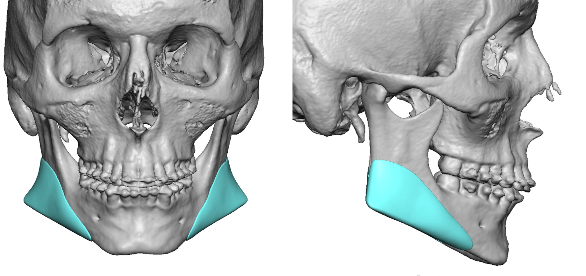 Custom-Jaw-Angle-Implant-design-Dr.-Barry-Eppley-Indianapolis.jpg