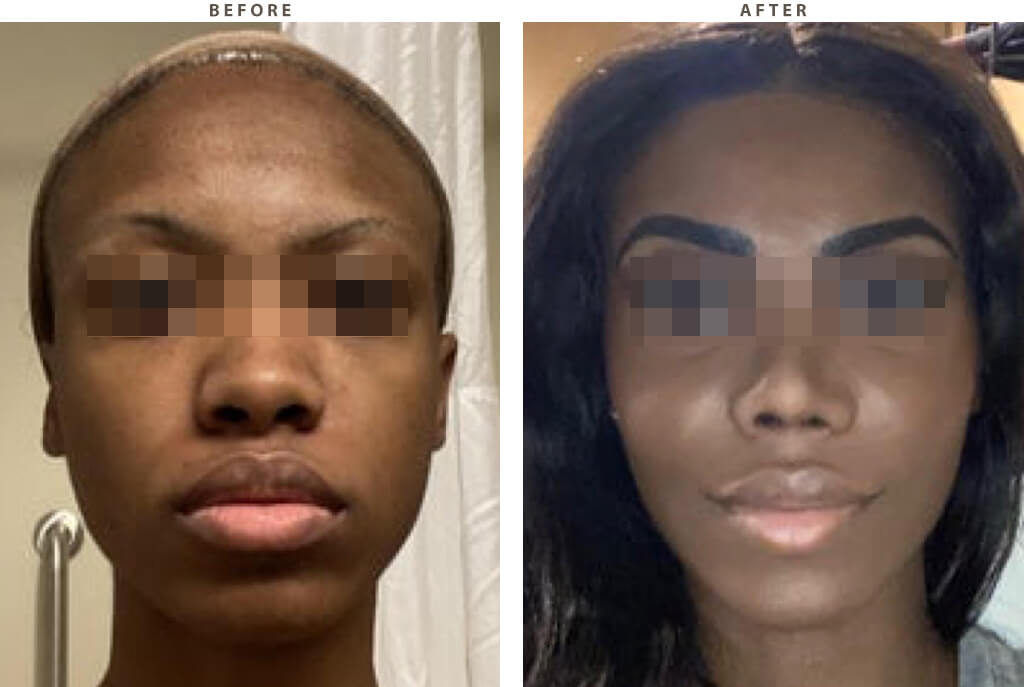 rhinoplasty-before-after-6646-01.jpg
