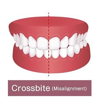 crossbite-684467.jpg