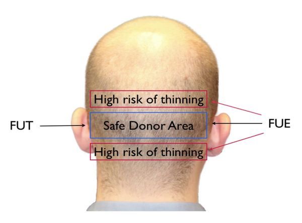 FUT-vs-FUE-donor-area-600w.jpg