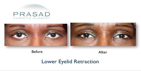 Lower-Eyelid-Retraction-Still-3.jpg