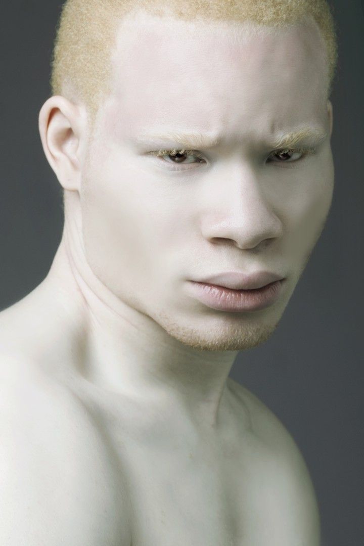 African Albino portrait