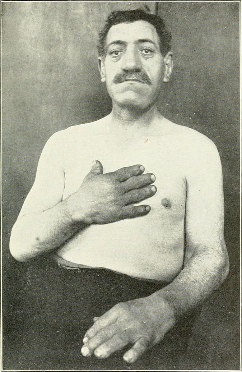 Acromegaly-male-patient-circa-1904.jpg