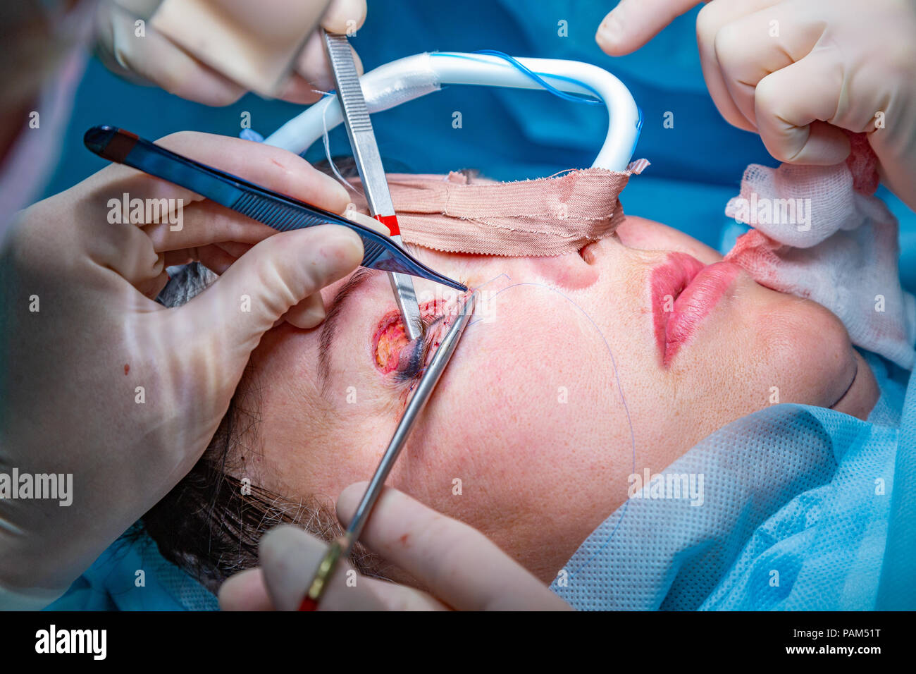 plastic-surgery-in-operating-room-PAM51T.jpg