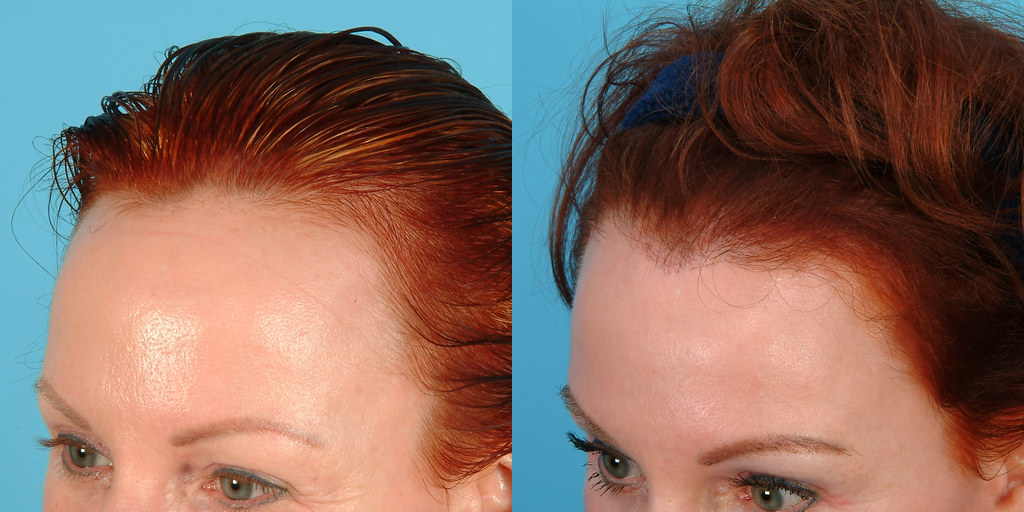 MMT-Hairline-Lowering-1.jpg