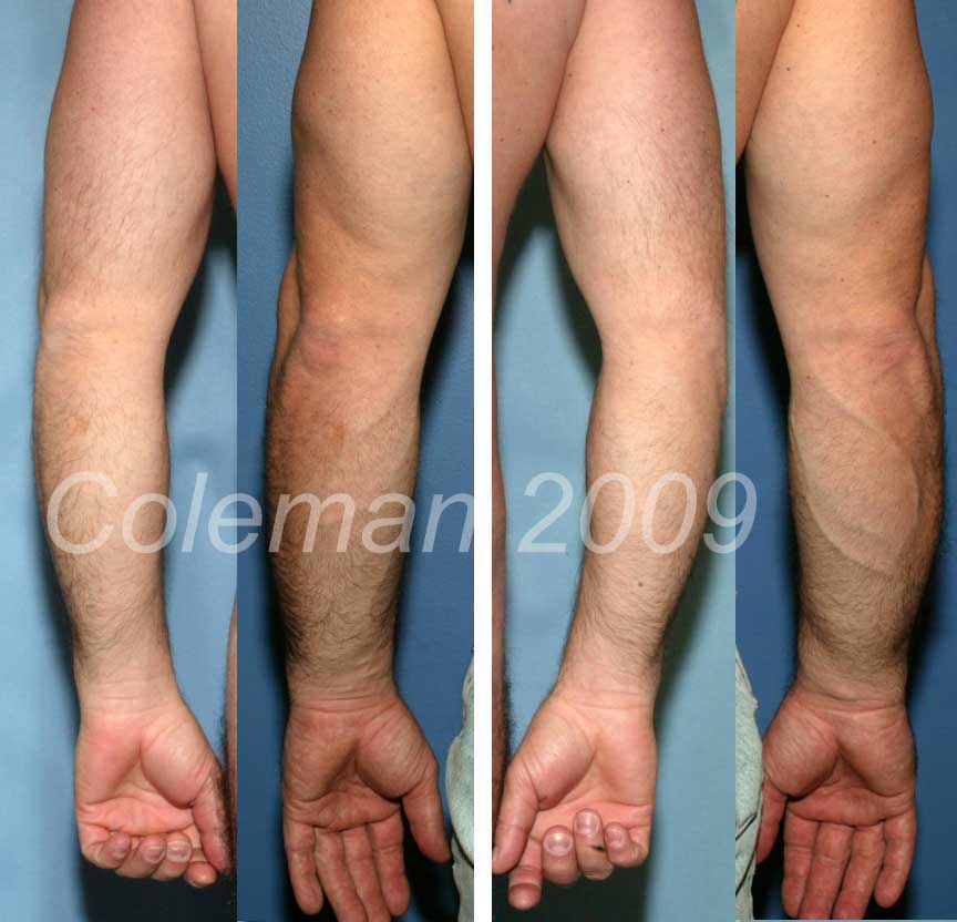 www.colemanlipostructure.com