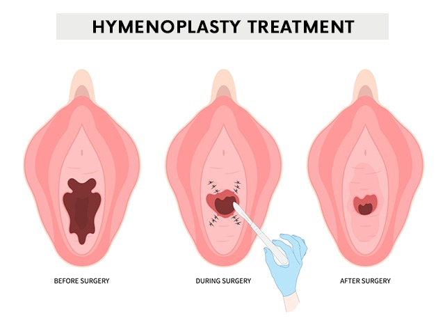Hymenoplasty - Colon Clinics