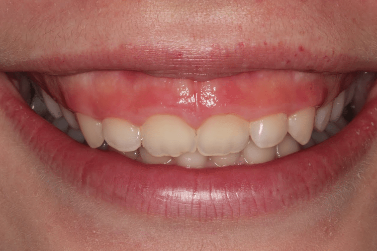 How to Fix a Gummy Smile | Dentistry for Madison LLC