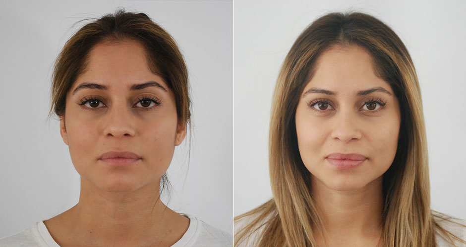 dermal-fillers-before-after-3.jpg