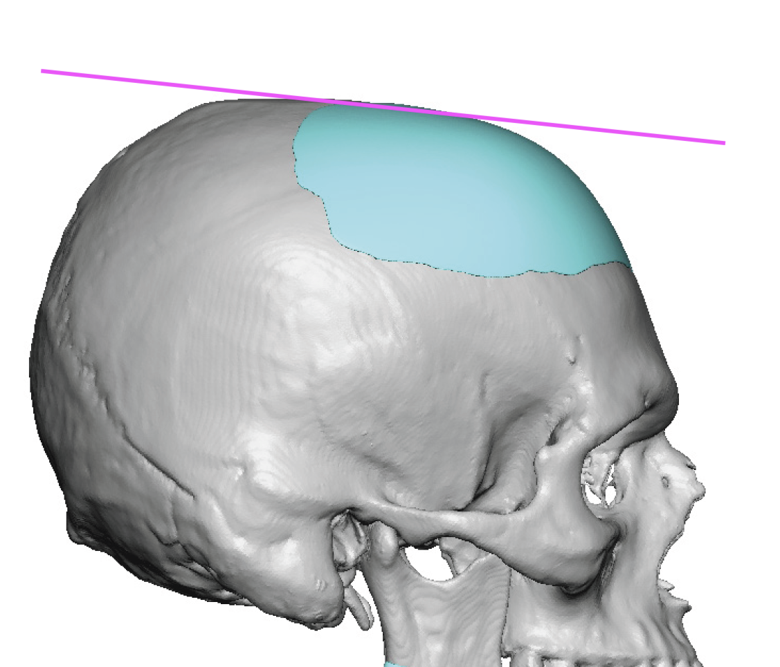 skull-forehead-slope-correction-with-custom-skull-implant-Dr-Barry-Eppley.png