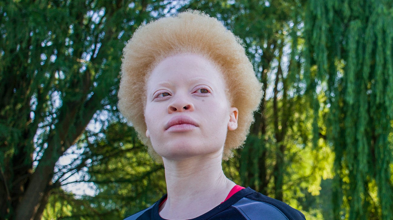 Albinism-OCA2-1296x728-slide2.jpg
