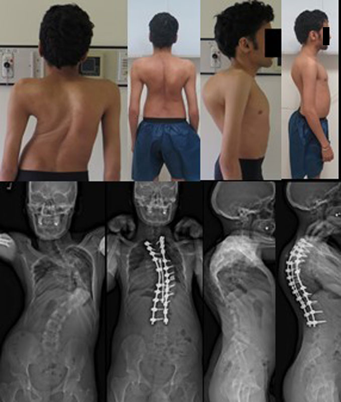 Section 9, Chapter 8: Osteotomies for Rigid Spinal Deformity: Evaluation,  Indications and Techniques : Wheeless' Textbook of Orthopaedics