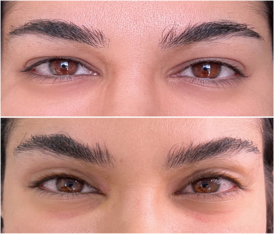Modified lateral canthopexy with upper and lower blepharoplasties for  aesthetic refinements: My personal technique - ScienceDirect