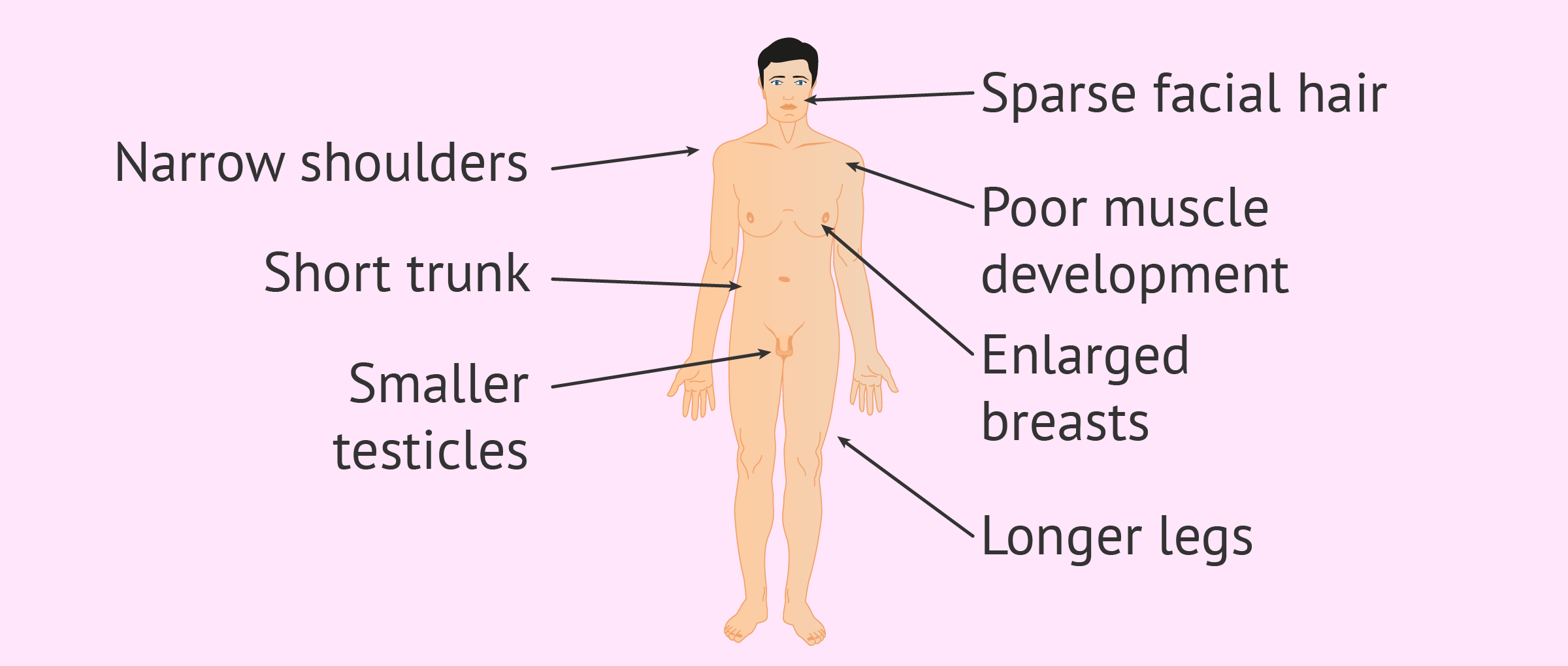 characteristics-of-klinefelter-syndrome.png