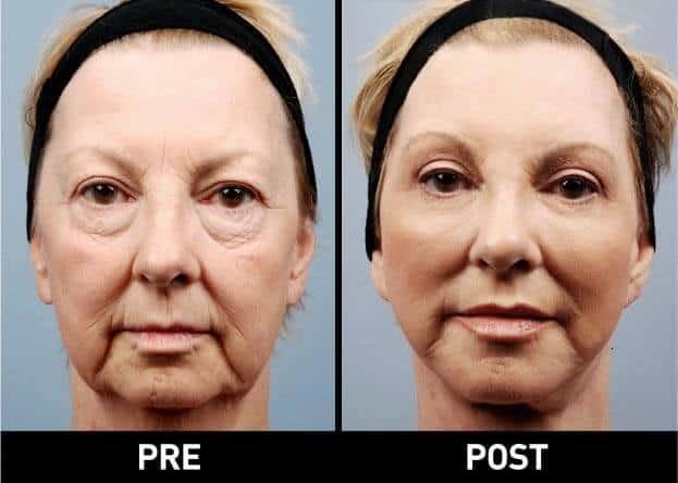 image1_surgical_facial-fat-transfer.jpg