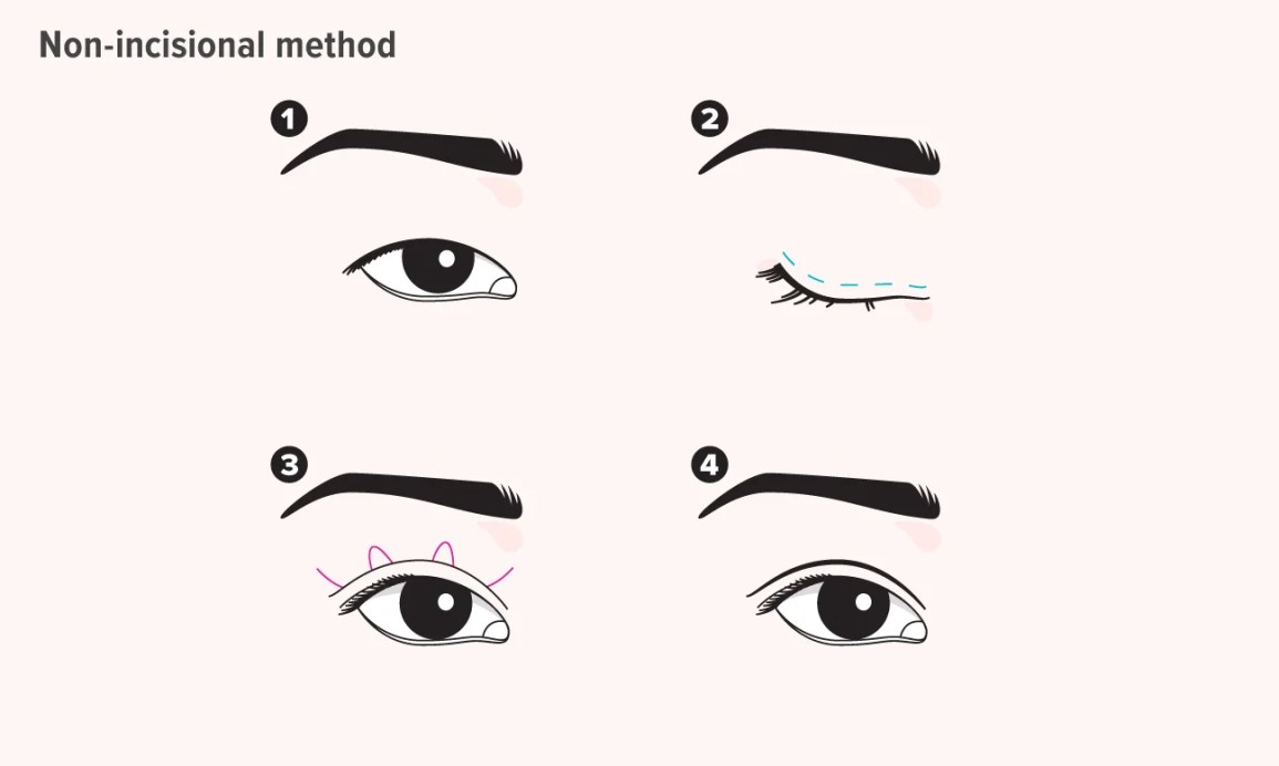 Image result for Double Fold Upper Eyelid