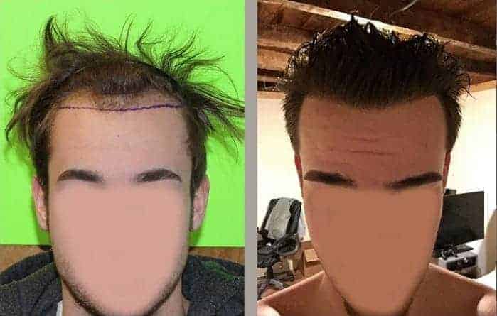 Creating a Low Hairline with Hair Transplant Surgery? | Feller & Bloxham  Medical