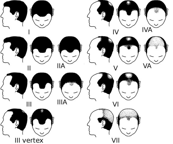 Hamilton-Norwood-Schema-Index.jpg