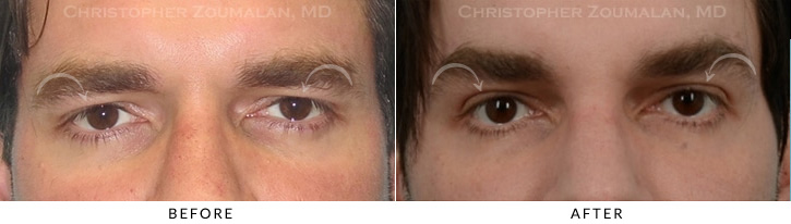 male-brow-lift-gal-3a.jpg